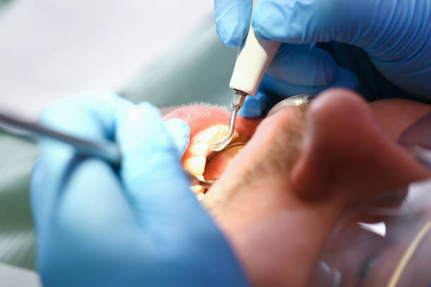 Best Emergency Root Canal Treatment in Fairlawn, VA