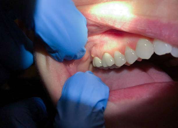 Best Emergency Dentist for Knocked-Out Tooth in Fairlawn, VA